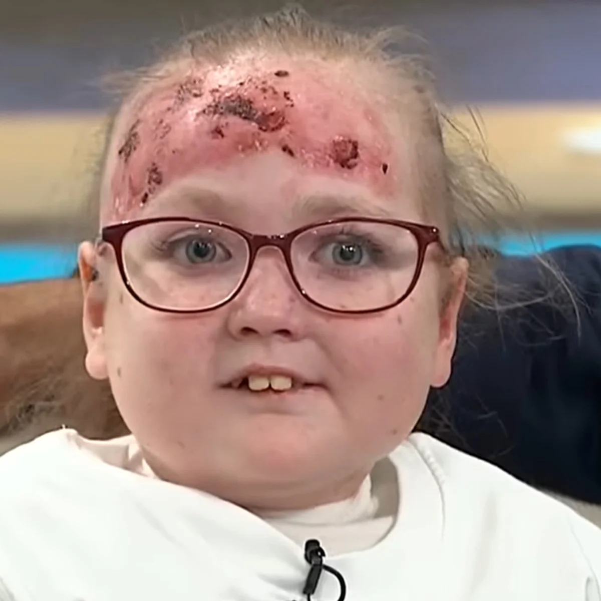 Doença rara deixa menina de 14 anos com bolhas e dor por todo o corpo