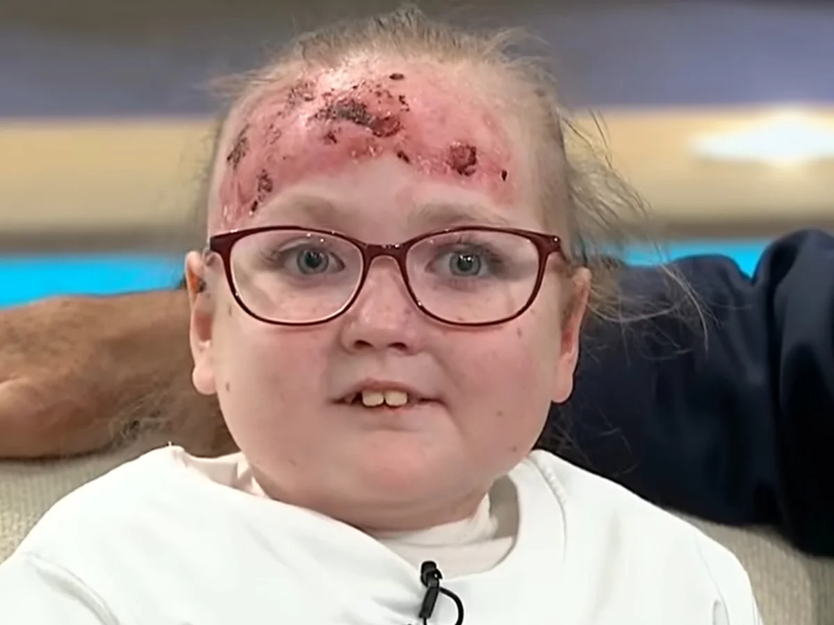 Doença rara deixa menina de 14 anos com bolhas e dor por todo o corpo